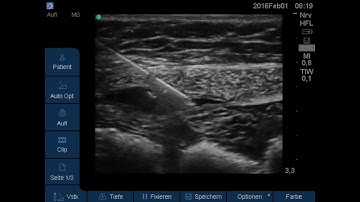 Rectus sheath block - needle guidance from lateral (right side) 133500