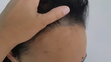 Healed Female Scalp Micropigmntation  SMP 1st session Hairline Density by El Trucha