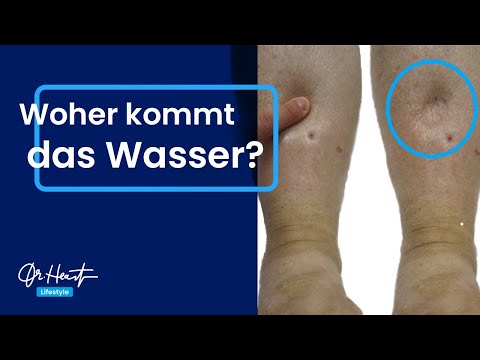 Video: Wenn Wassereinlagerungen gefährlich sind?