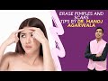 Erase pimples and scars dr manoj agarwala m a skin  hair superspeciality clinic