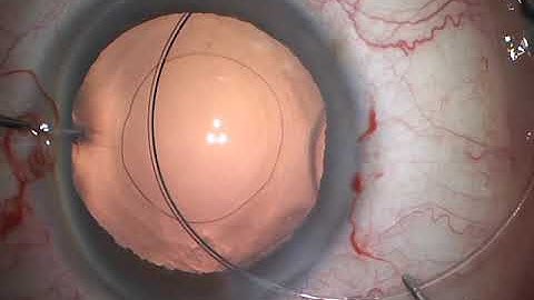 Capsular tension ring insertion - the basics