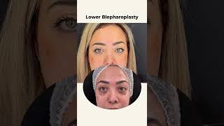 Lower Blepharoplasty: Smooth Under-Eye Bags | Dr. Saad Dibo