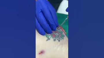 Thumbnail of Ever wonder how deep a tattoo penetrates your skin?!😱 #mommymakeover #liposuction #tummytuck #song