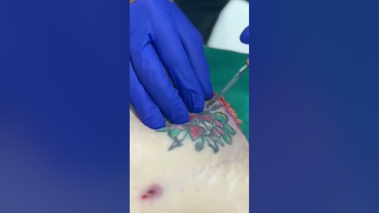 Ever wonder how deep a tattoo penetrates your skin?!😱 #mommymakeover #liposuction #tummytuck #song