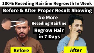 Miracle Hairline Regrowth: How to Restore Receding Hairline in Just One Week