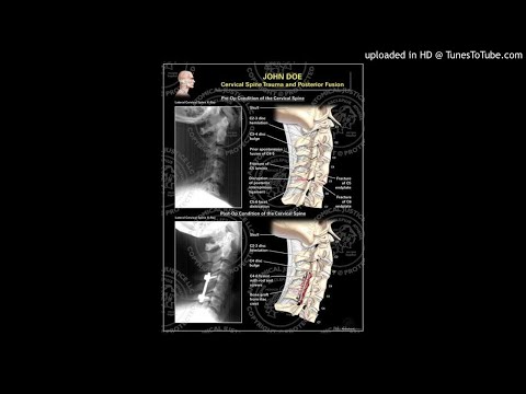 traumatic-cervical-fractures-in-patients-with-ankylosing-spondylitis