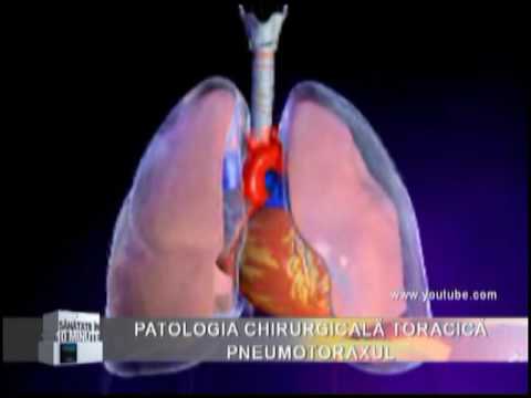 Video: O Acoperire Pleurală Totală A Ochiurilor De Celuloză Absorbabile Previne Reapariția Pneumotoraxului La Pacienții Cu Sindrom Birt-Hogg-Dubé