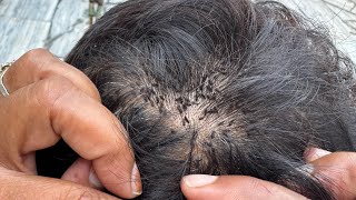 #licesremoval ‘Love vs Lice: Wife Takes on Husband's Hair 🐜💇‍♀️' Wife removed husband lice ||part81