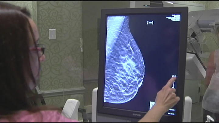 Doctor says new draft guidelines won't change her mammogram recommendations
