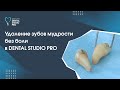 Удаление зубов мудрости без боли в DENTAL STUDIO PRO