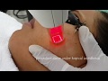 Laser treatment for acne scars - Fractional Non Ablative Laser - Dr. Anuj Pall MD, PhD, FISD (USA)