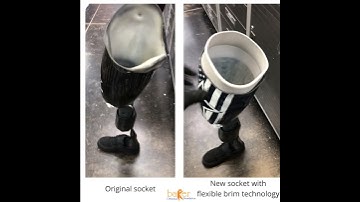 Our transfemoral patient was recently fit with a custom flexible brim socket after wearing tradition
