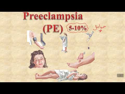 Videó: Preeclampsia - Fokok, Tünetek, Okok, Kockázati Tényezők, Kezelés