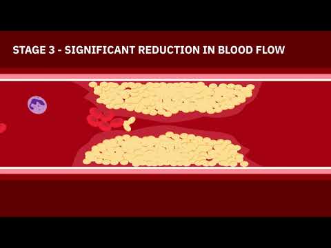 Videó: Miért alkalmazzák a koszorúér angiográfiát?
