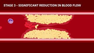 Coronary Artery Disease Animation screenshot 1