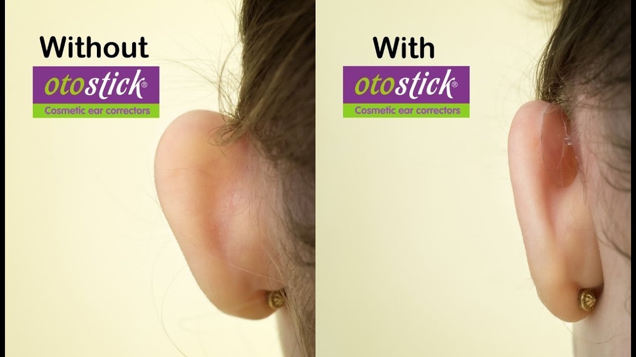 How to make your ears stick out less without surgery