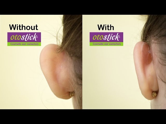 Otostick Cosmetic Ear Corrector for sale online