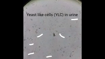 yeast cells in urine
