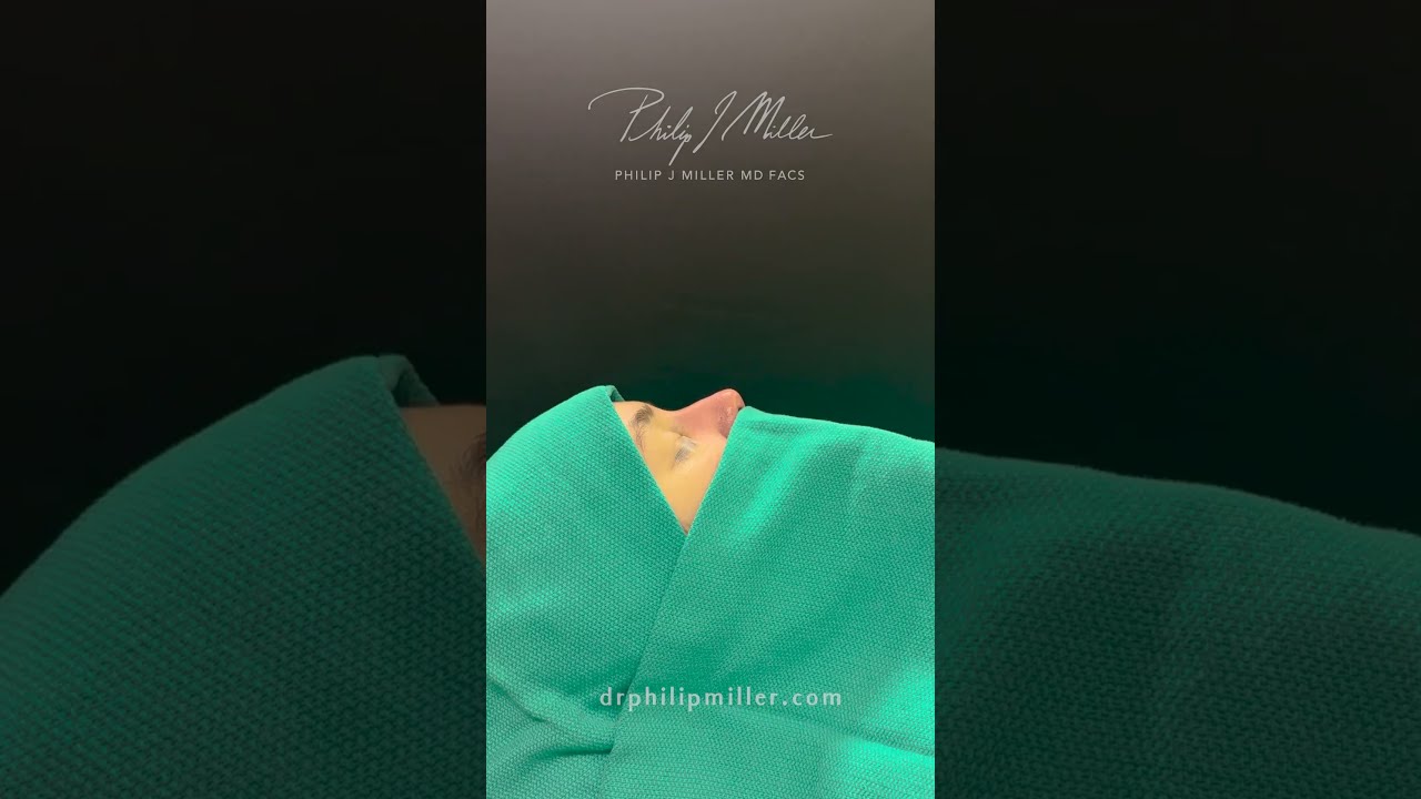 Immediate Rhinoplasty Table Results in NYC!