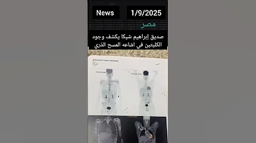 صديق ابراهيم شيكا بكشف وجود الكليتين في إشاعة المسح الذرى ابراهيم شيكا ترند ترند تيك توك ترندات 