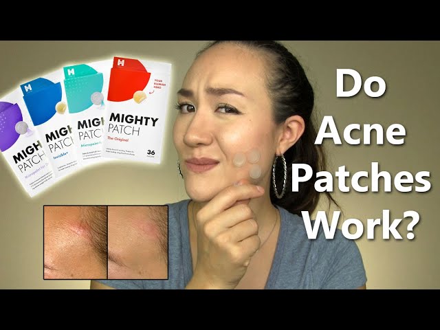 TESTING HERO MIGHTY PATCH & MICRO POINT ACNE PATCHES ON MY