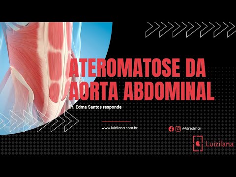 Vídeo: Aterosclerose Da Aorta Abdominal - Sintomas E Tratamento