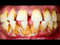 大規模な歯石の洗浄-歯石の除去 🦷 [Remove Massive Hidden Teeth Tartar] #88 DentalClinic