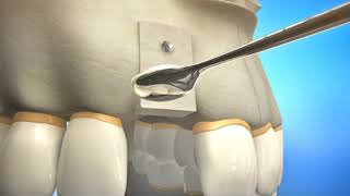 Bone Grafting Procedure Video Animation | Durham Dental Solutions screenshot 4