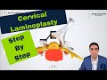 Laminoplasty - Motion preservation spinal cord decompression. Procedure, Risks, and Restrictions.