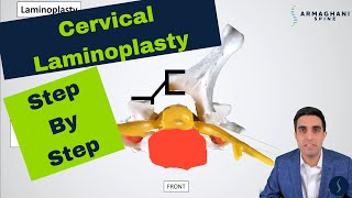 Laminoplasty  Motion preservation spinal cord decompression. Procedure, Risks, and Restrictions.