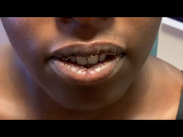 Dallas African Ethnic Revision Lip Reduction 3 Days Out