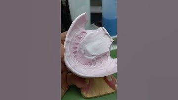 Making a retainer after composite bonding | retainer stuck