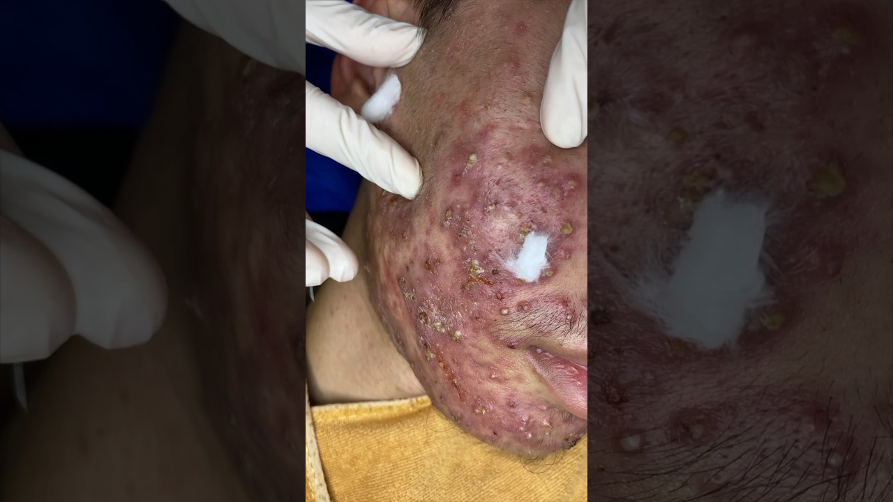 #sacdepspa #acne #treatments