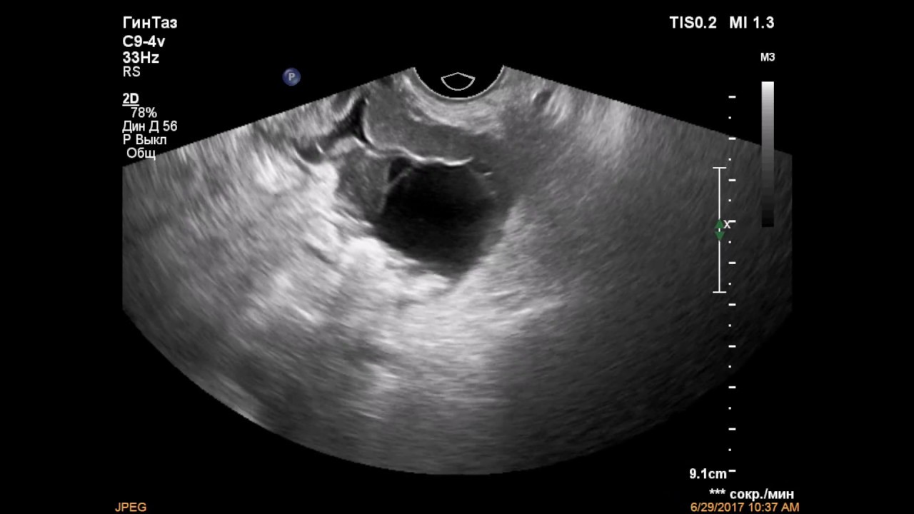 На узи не виден яичник. Объемные образования яичников на УЗИ.