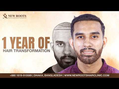 Amazing Hair Growth After Hair Transplant 😮 | 2500 Grafts | Hair Transplant Bangladesh | New Roots
