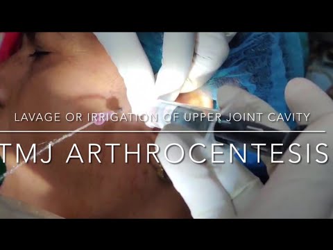 ARTHROCENTESIS||TMJ pain treatment||joint injection