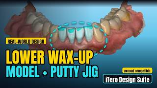 Real-World Lower Wax-Up in iTero Design Suite (Mistakes, Fixes & the Putty-Jig Workflow) News