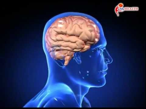 Video: Sakit Kepala Dan Pening: Migrain, Kecederaan Kepala, Dan Punca Lain