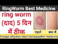 Ringworm (दाद) की best medicine || Fungal infection best medicine