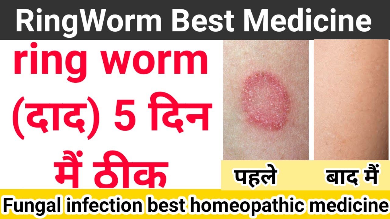 10 Best Natural Home Remedies For Ringworm Treatment