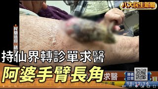 阿嬤手臂長角 持仙界轉診單求醫 |【民生八方事】| 2022111603 @gtvnews27