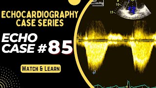 Echocardiography Case 85 Echo Case Series Echocardiogram Interpretation Made Easy For Beginners