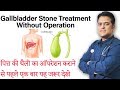 Remove gall bladder stone without surgery  treatment of gall bladder stone 
