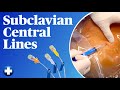 Subclavian central lines easy and safe landmark method