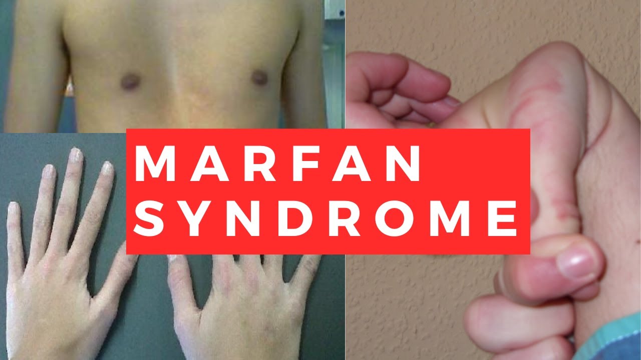 What is the Marfan Syndrome?