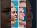 Fixing a Collapsed Nose 👃 | Dr. Daniel Becker on Revision Rhinoplasty