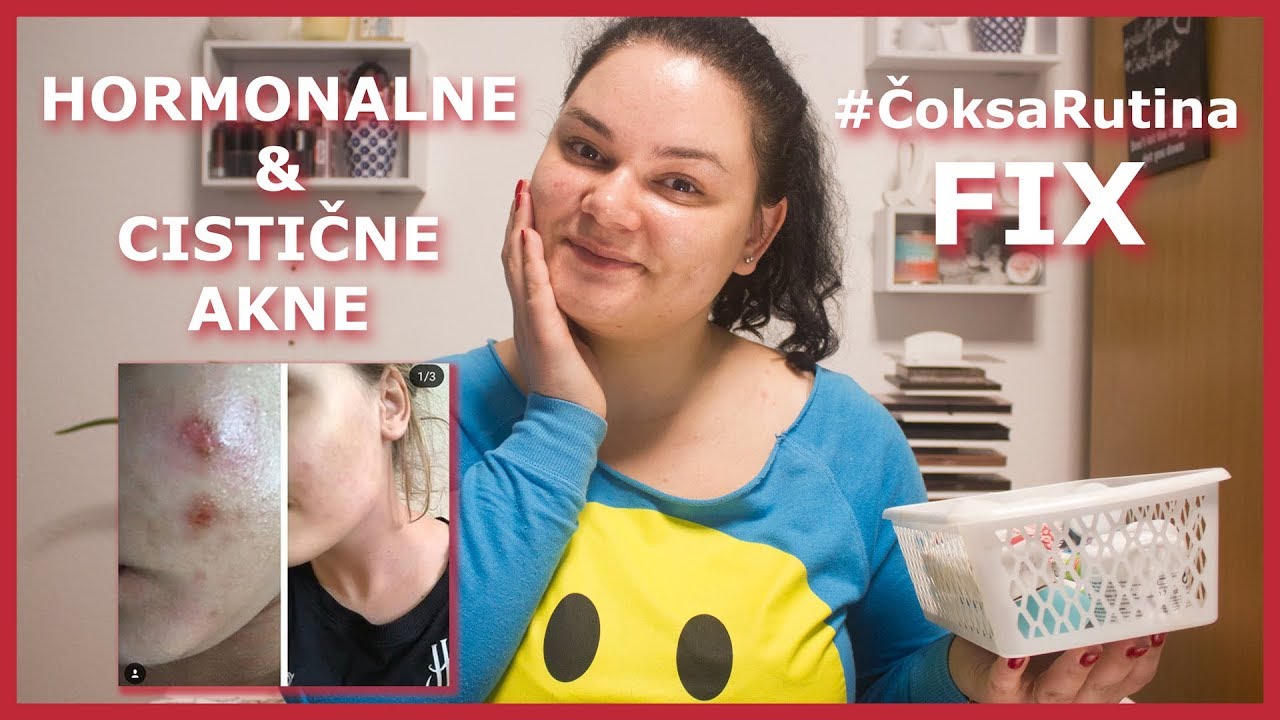 Hormonalne i cistične akne - kako ih se riješiti? | #ČoksaRutina FIX