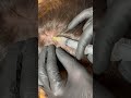 12 March 2026 #hair #mesotherapy #ASCE+