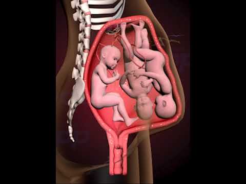 PRECIOUS MOMENTS OF TRIPLETS FIGHTING INSIDE THE WOMB 3D ANIMATION