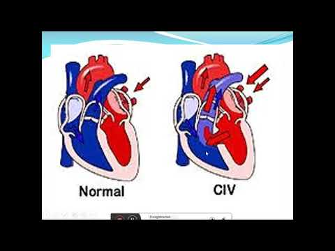 Vidéo: Communication Interauriculaire - Symptômes, Traitement, Formes, Stades, Diagnostic